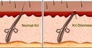 Kasıkta Kıl Dömesi Belirtileri ve Tedavisi